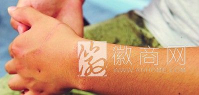 <a href='display.asp?id=14024' target='_blank'>肥西</a>周传金 周传金左手疤痕清晰可见