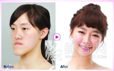 滁州 韩国整容真人秀 整容